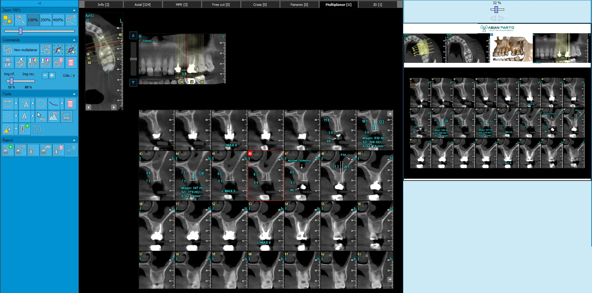 تصویربرداری CBCT و برنامه‌ریزی ایمپلنت