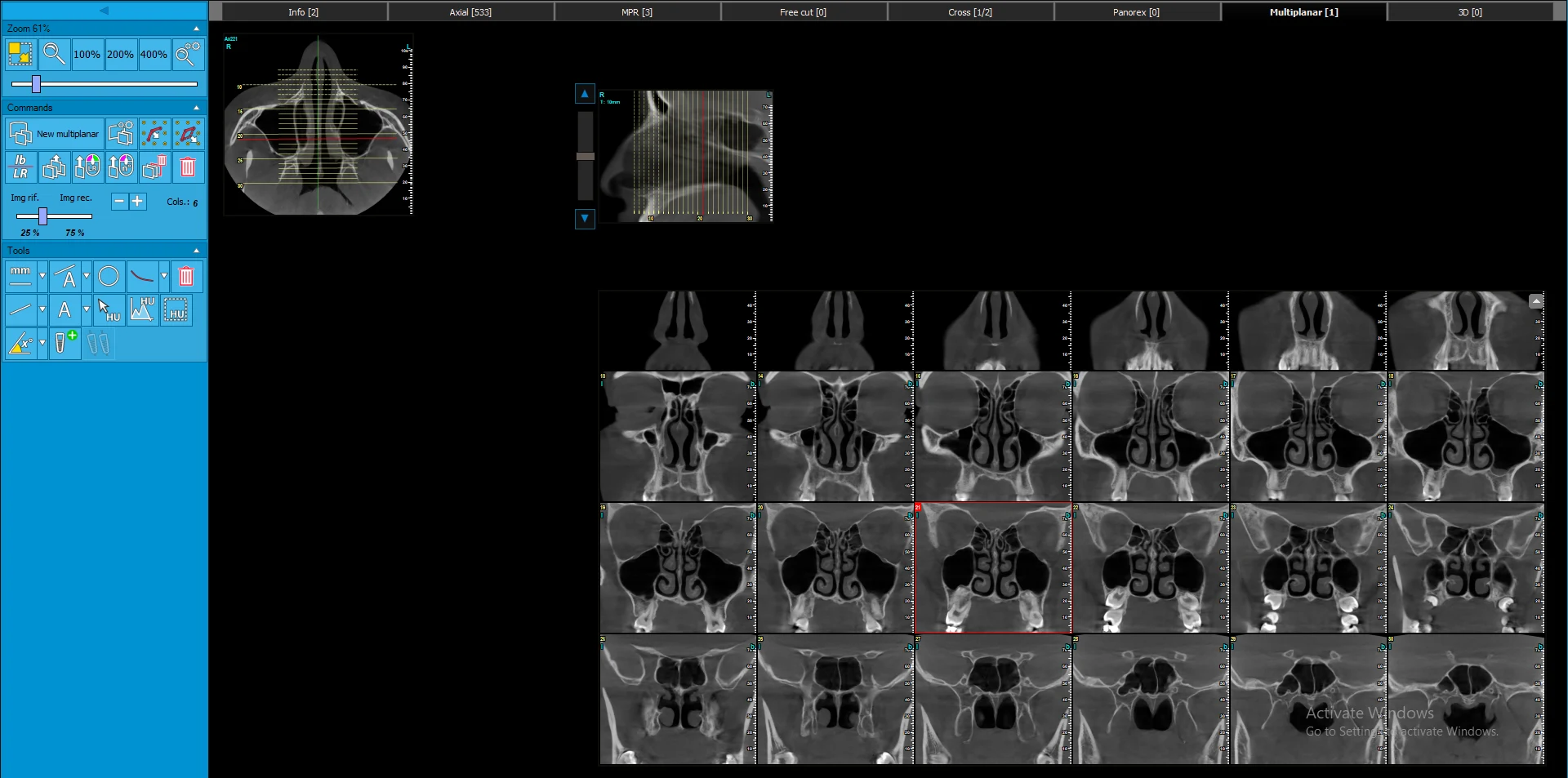 بررسی تخصصی سینوس و ساختار فک با CBCT